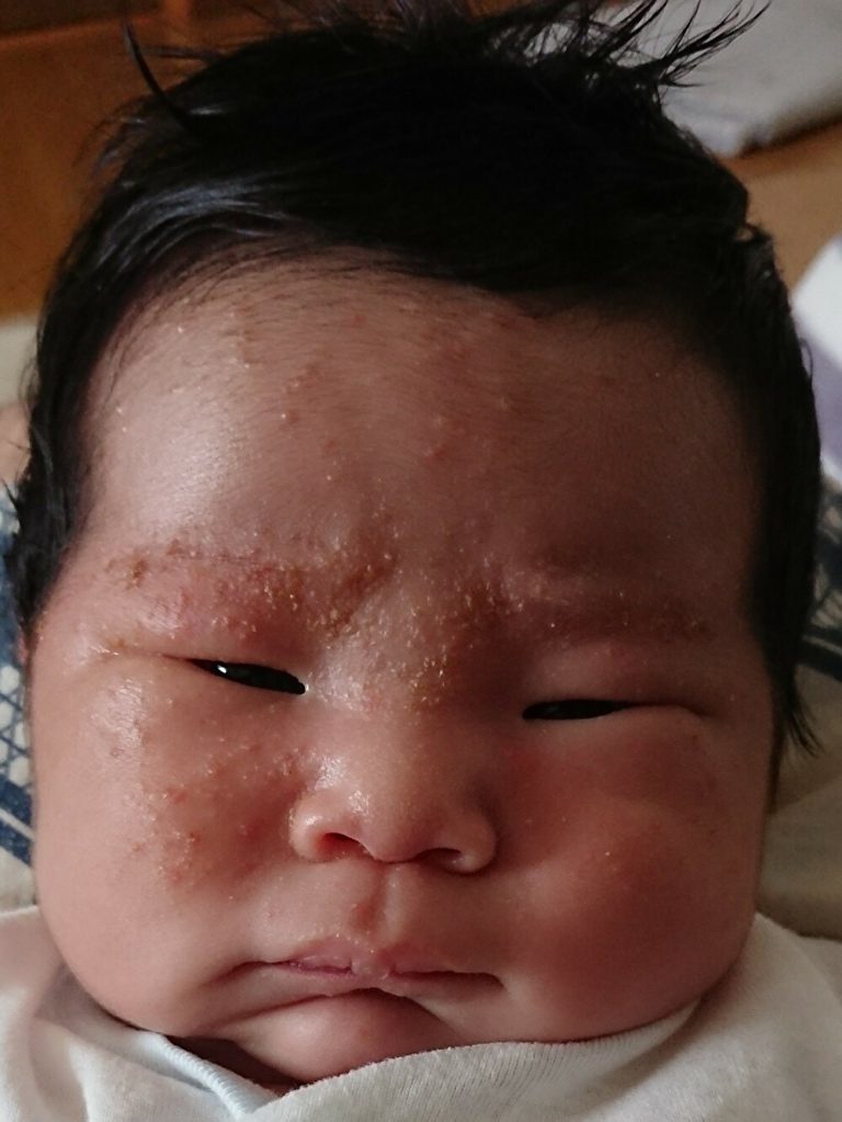 赤ちゃん 頭皮 湿疹