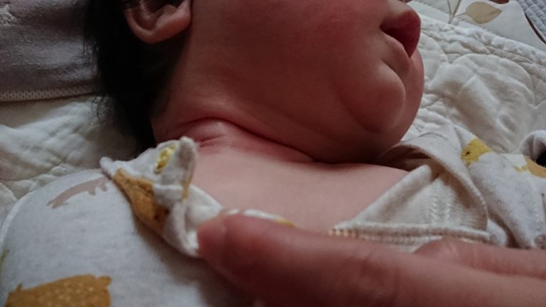 意外な方法も 首などの赤みの対処 中年おじさん育児日記